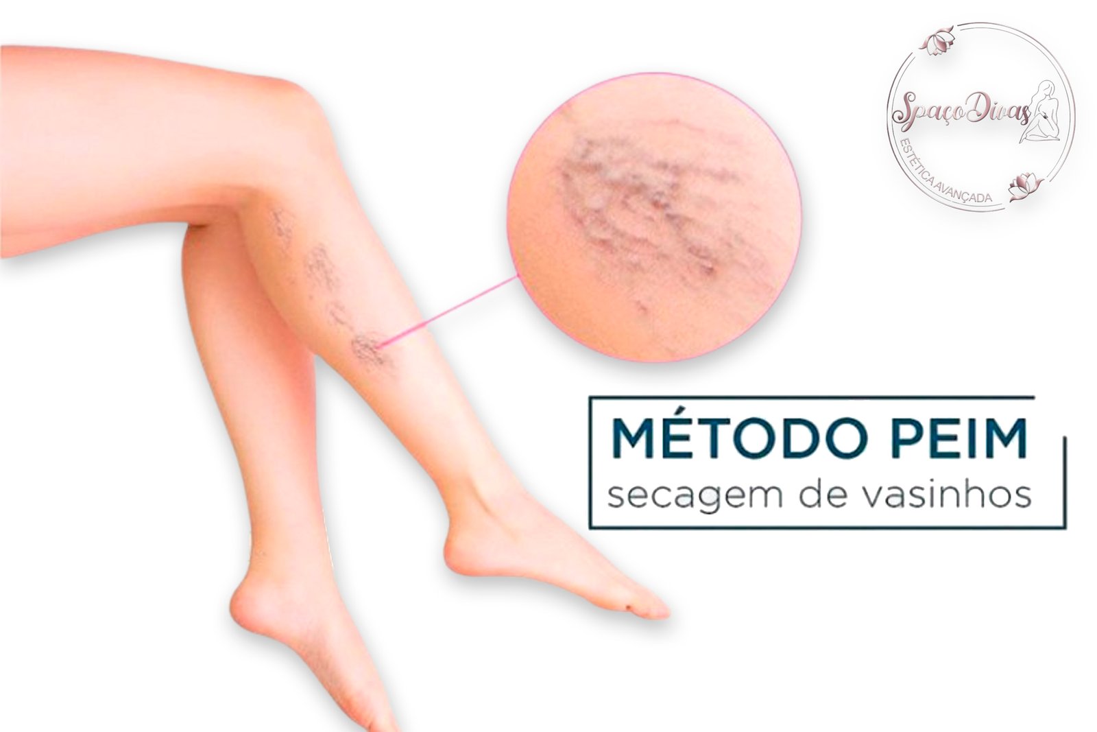 01 SESSÃO DE PROCEDIMENTO ESTÉTICO INJETÁVEL PARA MICROVASOS (PEIM) COM ANESTÉSICO com retorno. REALIZADO POR UMA BIOMÉDICA.